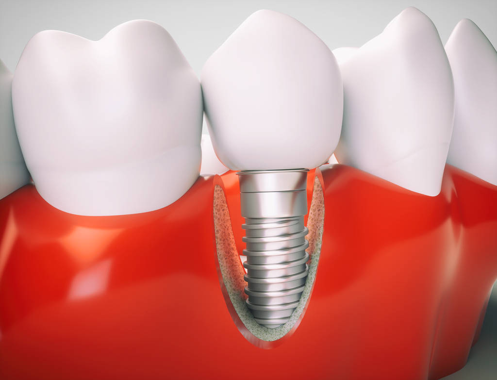 single tooth implant cost australia