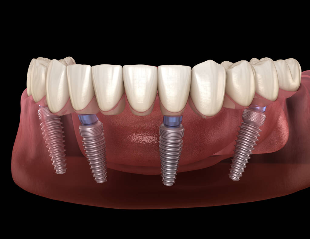 All on four dental implants cost
