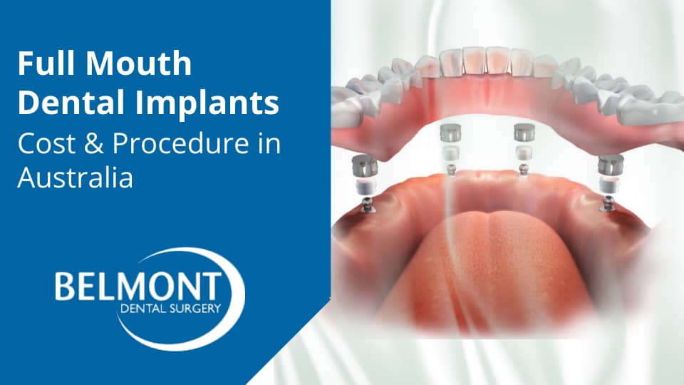 Full Mouth Dental Implants Cost & Procedure in Australia
