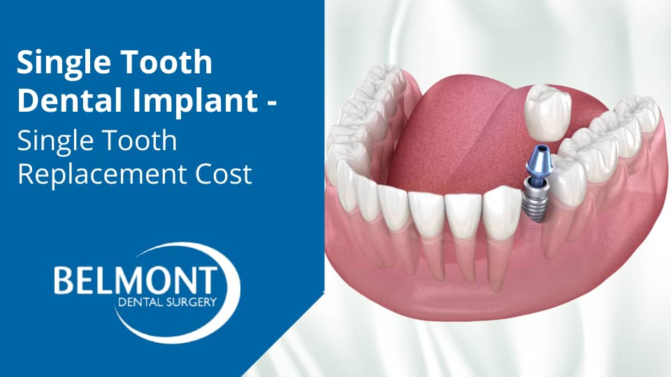 Single Tooth Dental Implant - Single Tooth Replacement Cost