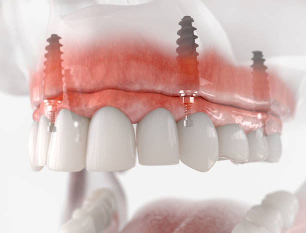 Affordable Dental implants in Perth Cost